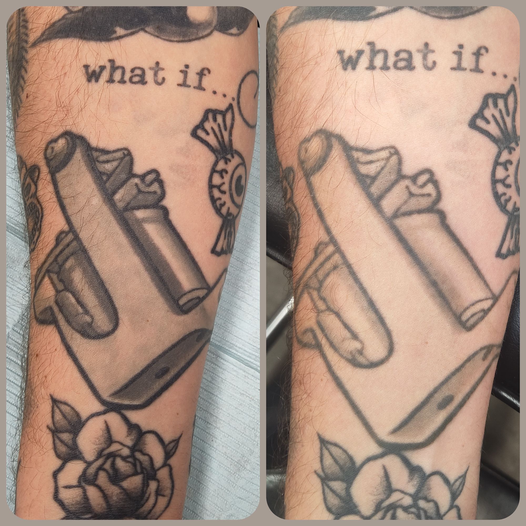 A side by side tattoo removal comparison after a session